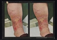 Eczema Varicosum